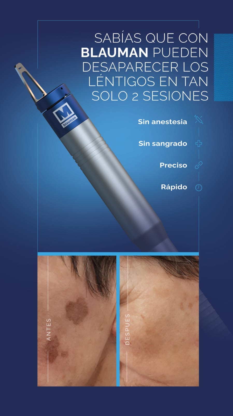 Láser azul antes del verano: piel limpia sin imperfecciones